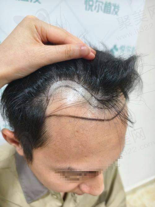 一、张久赋植发医生简介