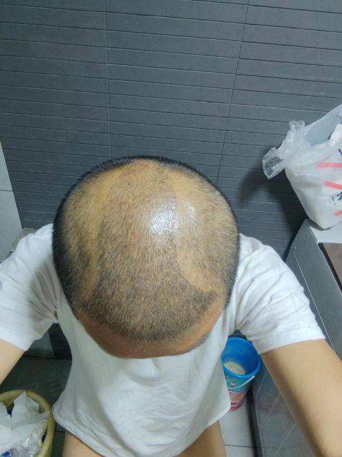 三、广州碧莲盛植发医生介绍: