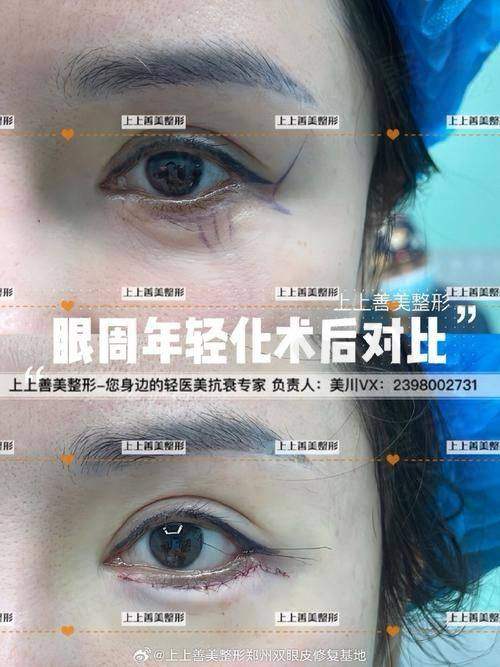 四、黄小林医生开眼角手术的精细操作