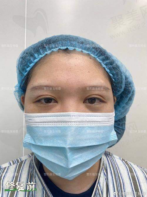 三、黄小林医生开眼角手术的个性化方案制定