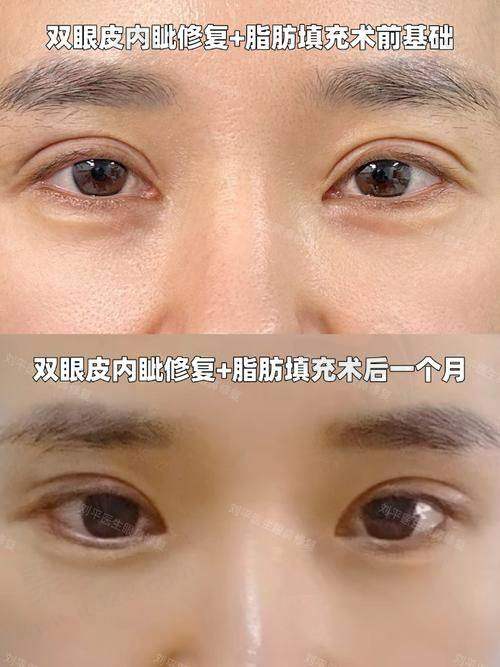 二、黄小林医生开眼角实例展示