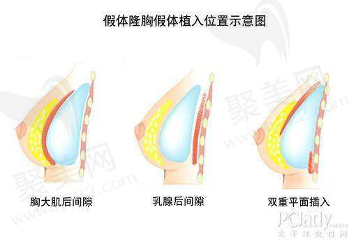 五、隆胸手术的注意事项