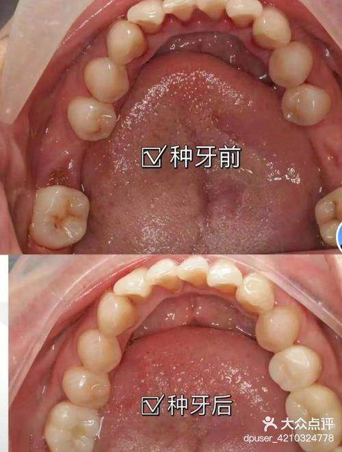 三、不同品牌种植牙的价格举例