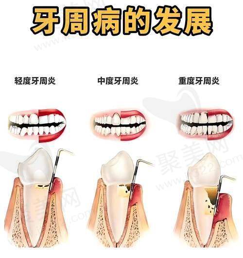 AO自锁牙套的优势