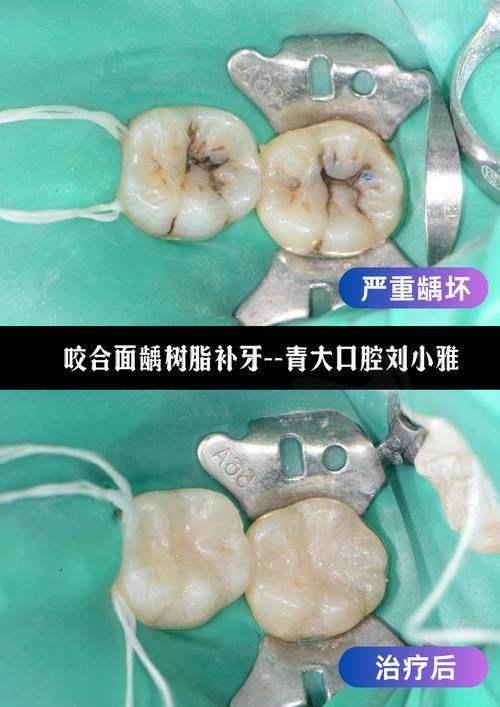 徐州美奥口腔医院儿童玻璃离子补牙原价280元，现89元起性价比超高快来抢