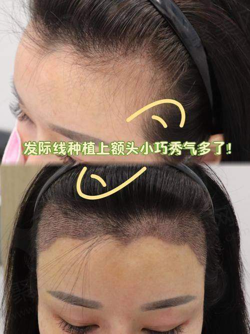 二、哈尔滨211医院植发技术优势