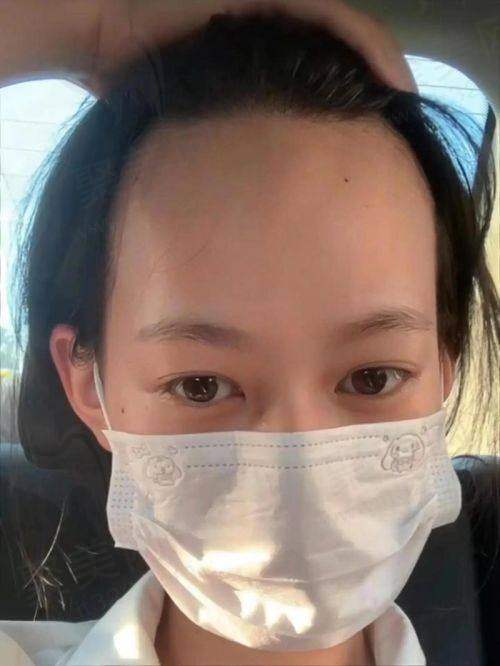三、哈尔滨211医院植发患者评价实例