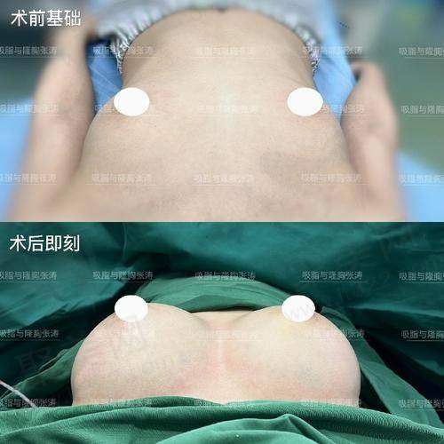 沈正宇和夏建军隆胸谁的技术好？价格与口碑情况