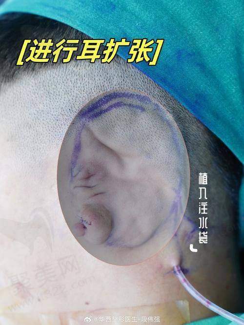 二、王冰清医生擅长的耳整形项目