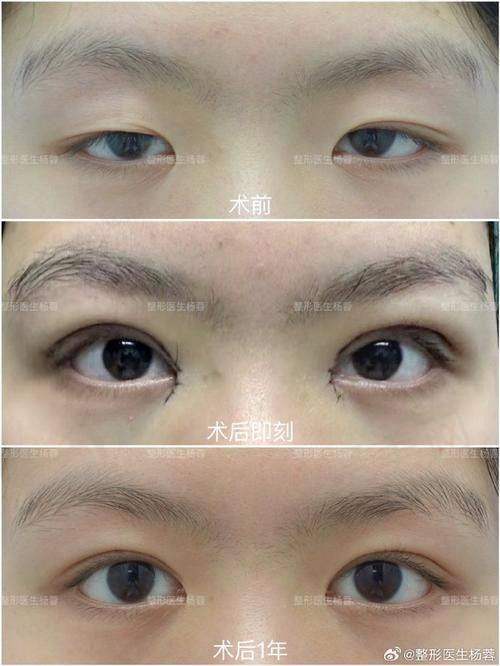 孙景波医生双眼皮技术好吗？从资历、案例及修复优势看其双眼皮实力几何