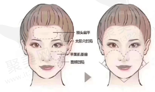 成都素美邵起可自体脂肪全脸填充项目的技术优势有哪些呢？