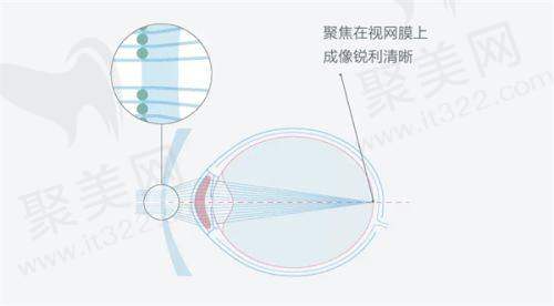 保定新视眼科医院收费标准是怎样的？