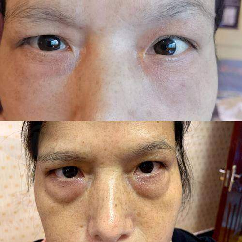 成都素美整形杨迪内切去眼袋+眶隔释放2999元起，隐蔽创口短恢复还能一举两得