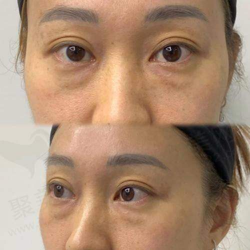 成都素美整形杨迪内切去眼袋 + 眶隔释放技术有什么优势？