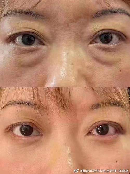 成都素美整形杨迪内切去眼袋 + 眶隔释放适合哪些人？