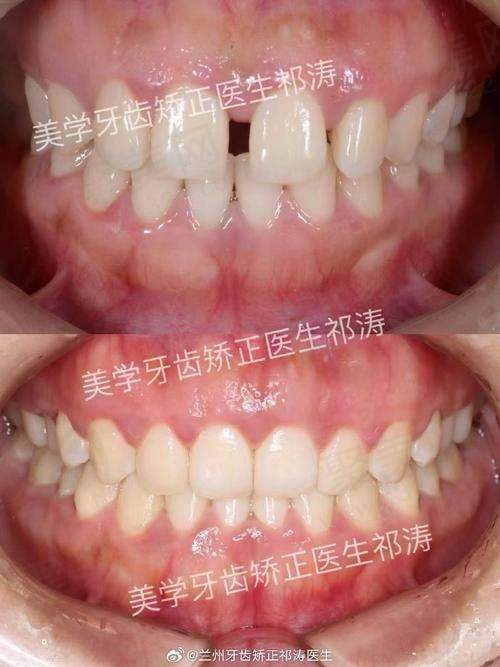 广州德伦口腔时代天使隐形矫正30000元起是如何定价的？