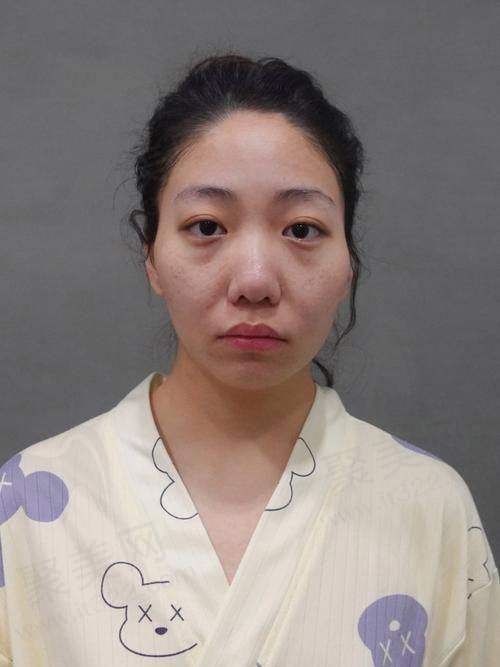 成都素美邵起可医生在自体脂肪全脸填充方面水平如何呢？