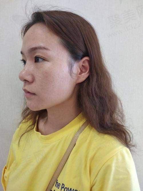 成都素美邵起可自体脂肪全脸填充价格4899元起，安全自然还能改善轮廓抗衰！