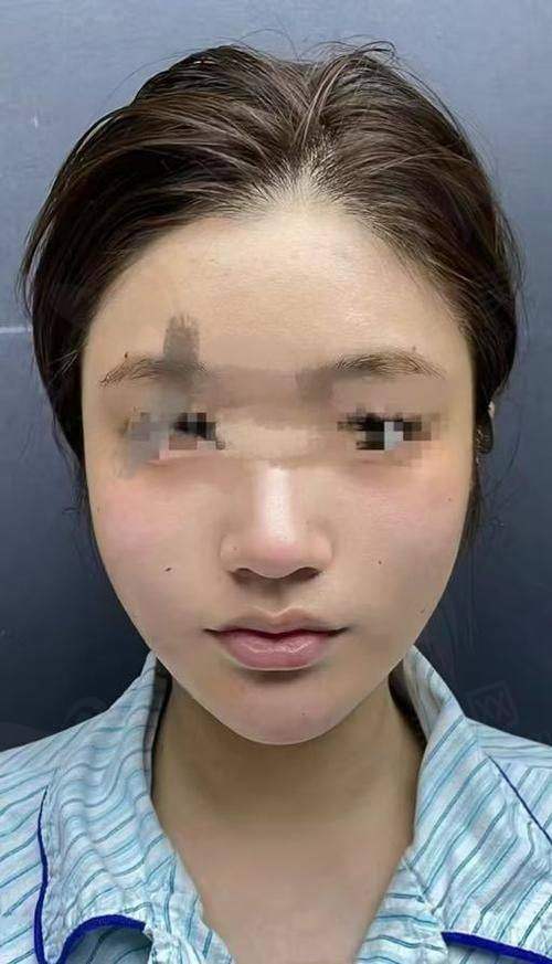 成都素美医院在自体脂肪全脸填充方面怎么样呢？