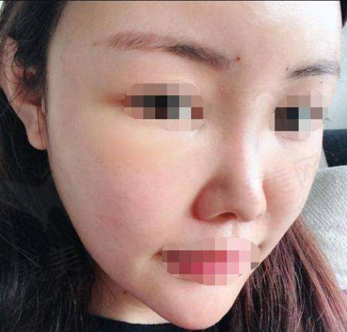 成都素美邵起可自体脂肪全脸填充项目有什么作用呢？