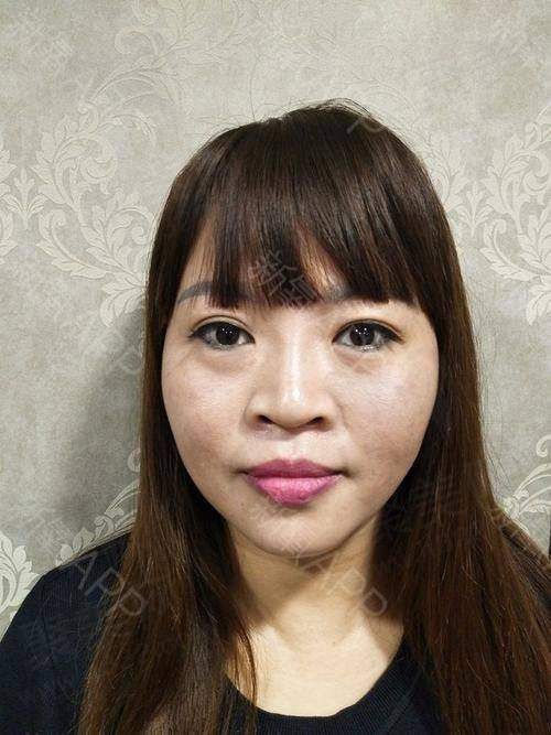 成都素美韩士生科进口假体隆下巴的技术优势有哪些？