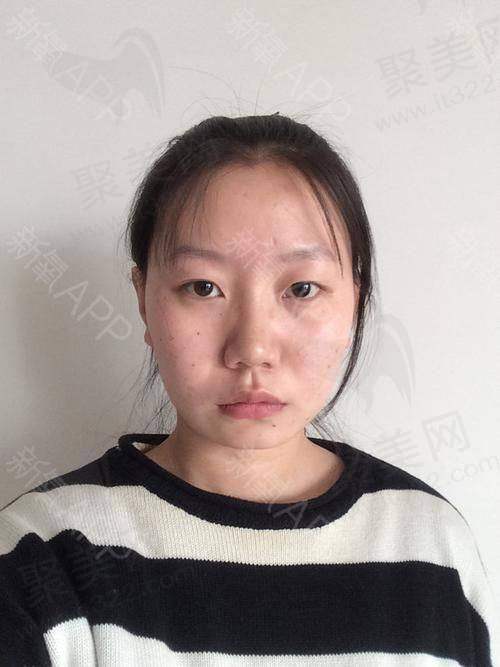 成都素美卢元刚韩士生科进口假体隆下巴4800元起，优质材质+个性定制打造自然美下巴