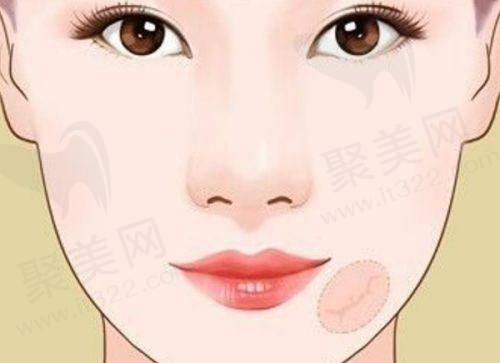 成都李瑞萱的连续缝合技术能带来什么成效