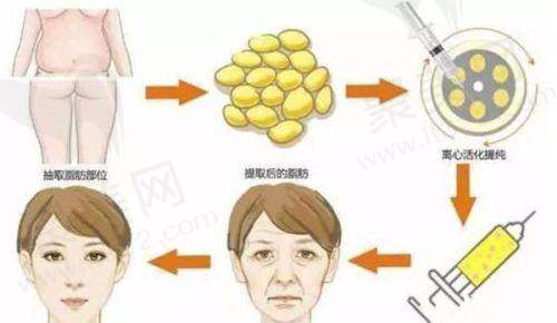 影响卢尚兵双眼皮手术价格的因素有哪些？