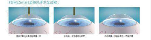郑州视光眼科医院收费标准参考