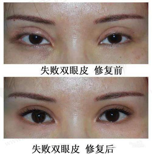 长沙张姣姣医生的双眼皮修复技术如何？张姣姣双眼皮修复技术评测、价格透明、成功实例多！