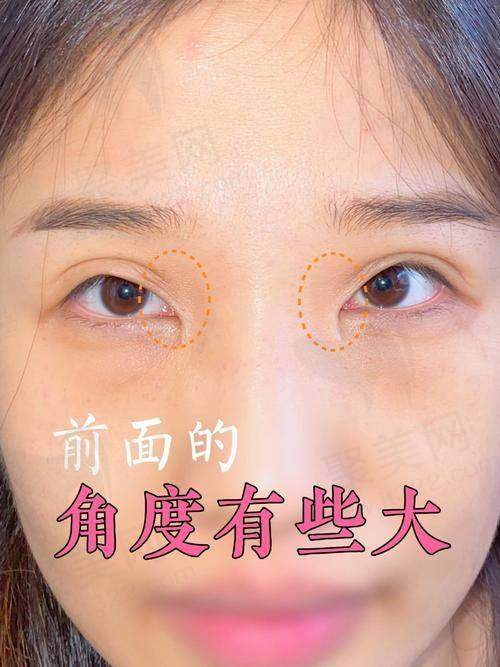 长沙张姣姣医生双眼皮价格：你值得了解的收费情况