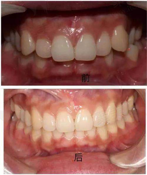深覆合二度：中度详细分析