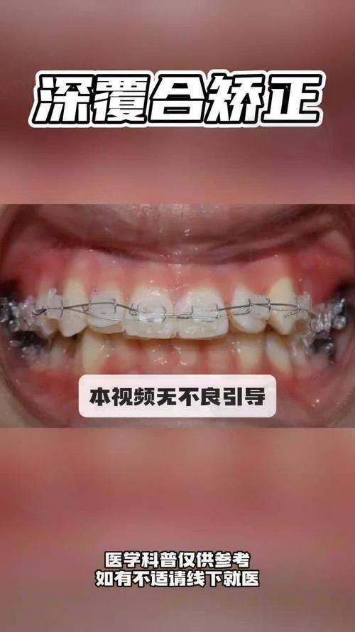 深覆合的疾病影响及必要性