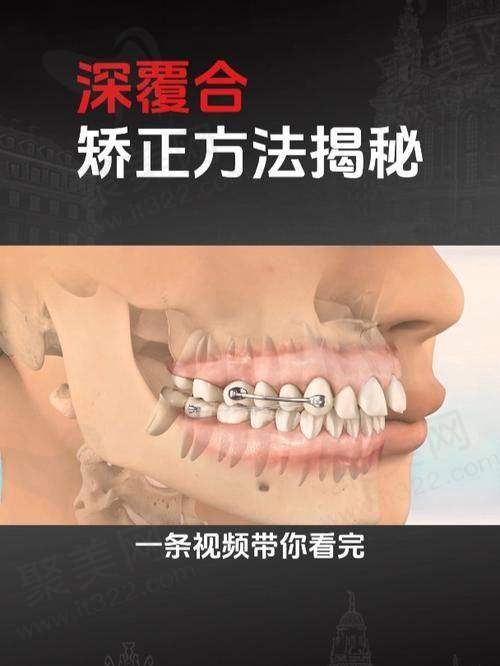深覆合治疗费用和实际实例解析
