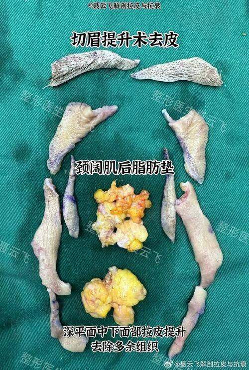 北京黄寺刘文阁拉皮技术怎么样？黄寺医院刘文阁医生技术卓越，拉皮、吸脂及面部提升手术效果显著
