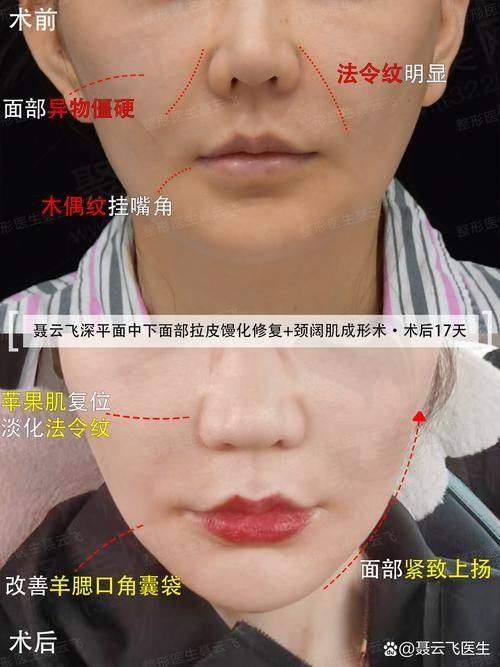 真实实例：刘文阁医生的成功手术故事