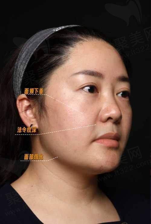 总结：微拉提手术的综合评估与建议