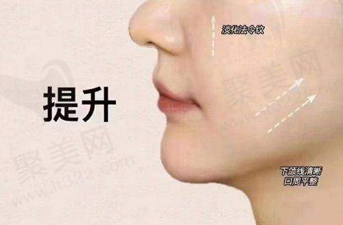 深圳陈群筋膜提升手术价格