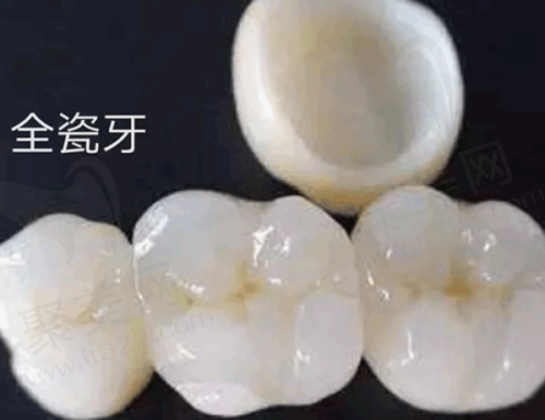 芜湖市三十二颗牙诊所种全瓷牙多少钱一颗