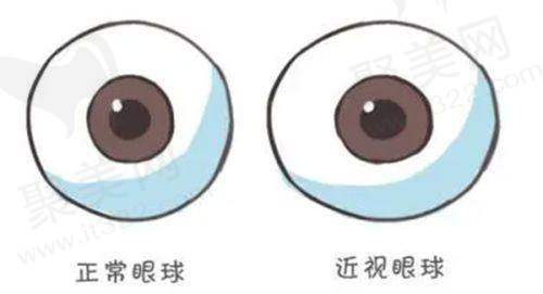 郑州爱尔眼科医院消像差飞LASIK手术有哪些优势？