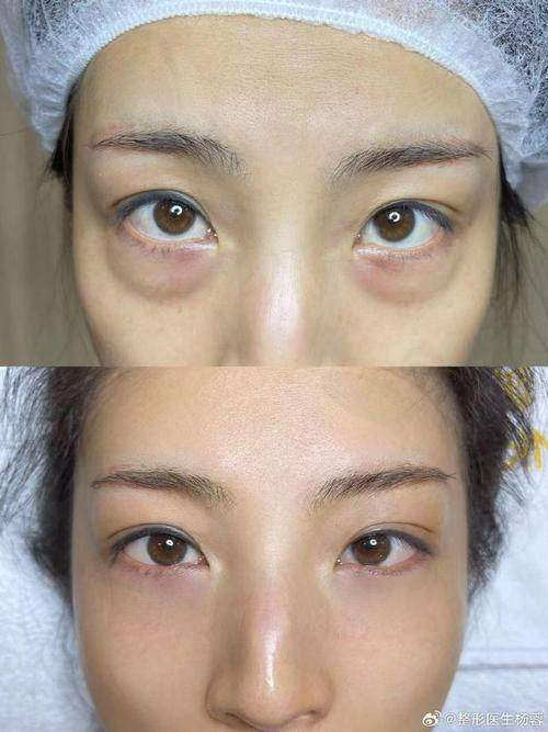 上海华美医疗美容医院胡小清内路祛眼袋7750元起,无痕恢复快,个性化方案效果佳!