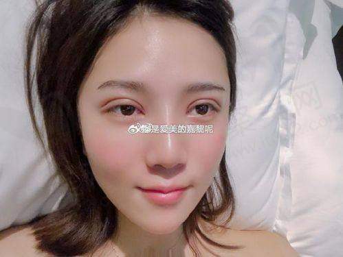 成都友谊整形切开双眼皮+开内眼角+轻度去脂去皮4项有成功实例吗？
