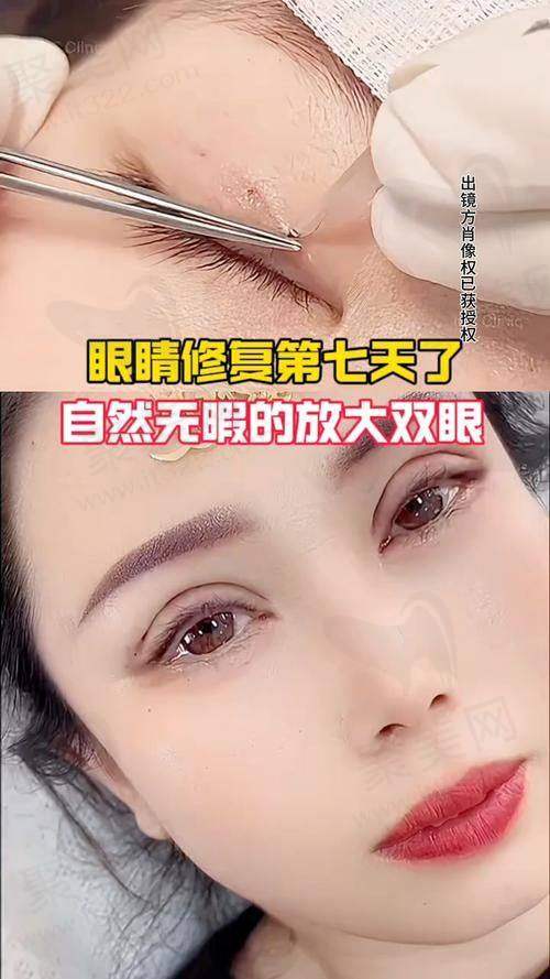 上海爱尚丽格肉条眼切开双眼皮修复原价4万起，限时3.2万起，闭眼无痕速冲！