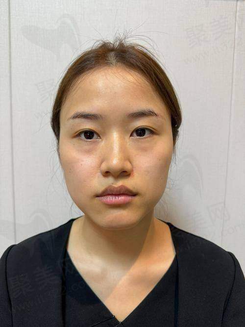 深圳阳光童晓钦注射乔雅登雅致玻尿酸的优势