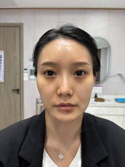 深圳阳光童晓钦注射乔雅登雅致玻尿酸项目价格