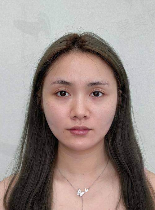 上海薇琳李花停医生审美真的自然吗？患者亲身体验告诉你
