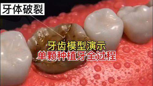 成都医大口腔张雷医生瑞典诺贝PMC种植牙价格8490元起，多优势护航缺牙患者轻松种牙