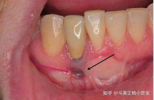 成都医大口腔的张雷医生技术如何？