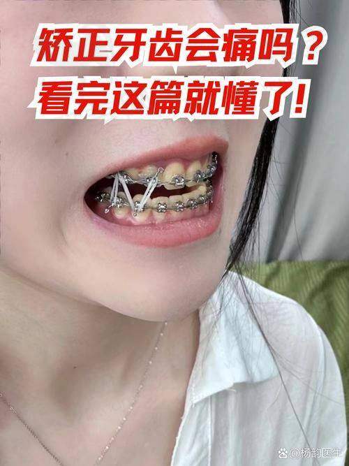 普特五代自锁托槽的临床优势