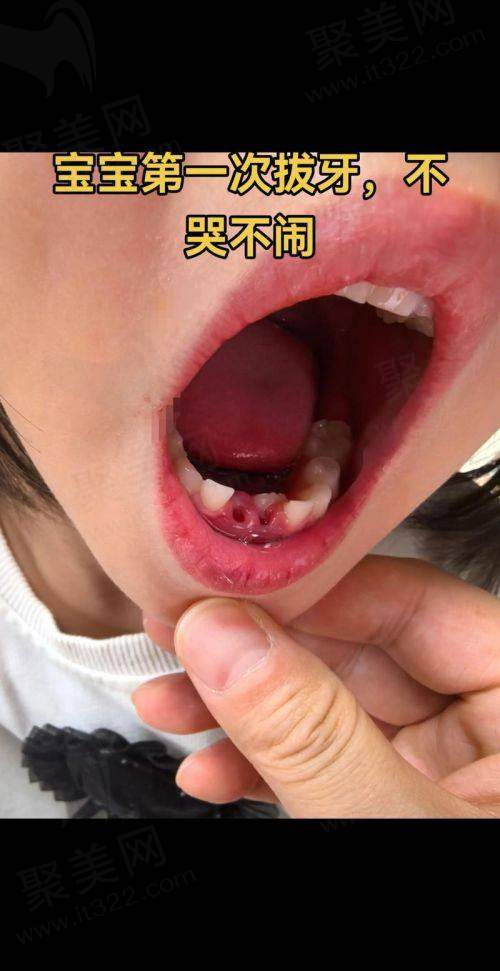 重庆团圆口腔医院其他儿童口腔项目配套